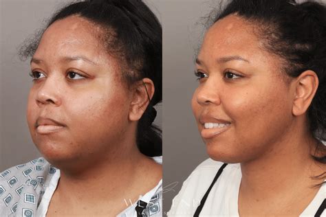 Buccal Fat Removal Washington DC - Cheek Fat Removal Surgeon