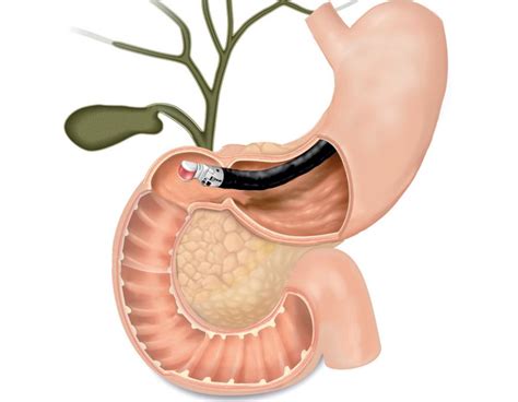 Endoscopic Ultrasound Procedure in SG | United Gastro and Endoscopy Clinic