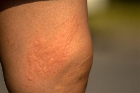 Causes of Rash on Inner Thigh and Treatment - Charlies Magazines