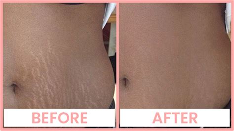 Laser Stretch Mark Removal in Chandigarh