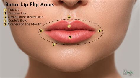 How Long Does Botox Lip Flip Last? Lip Flip Procedure & Aftercare