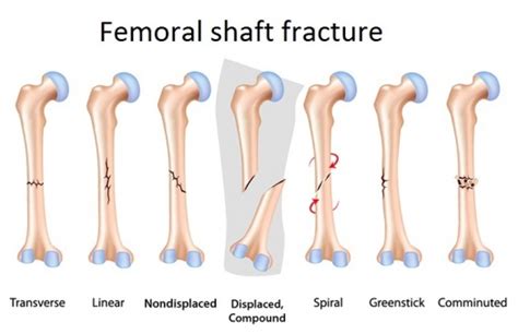 Femoral Fractures - Physiopedia