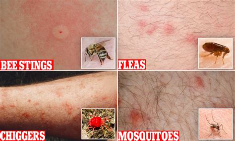 Mosquito Bites Vs Flea Bites