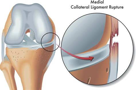 The Complete Guide to MCL Injury: Symptoms and Recovery