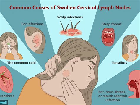 How To Check If Your Lymph Nodes Are Swollen - Birthdaypost10