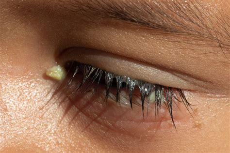 Crusty Eyes in the Morning: Causes & Treatment