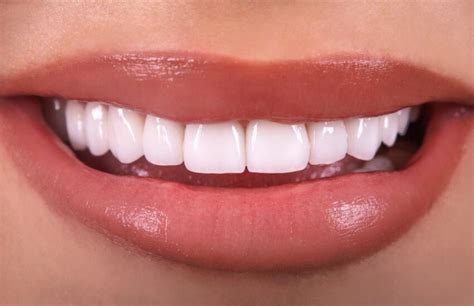 Porcelain veneers: The pros and cons