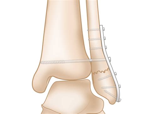 Lateral Malleolus Of Fibula