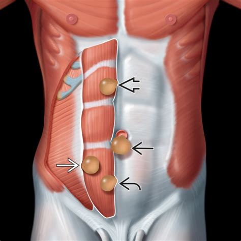 Abdominal hernia pictures – Infinings