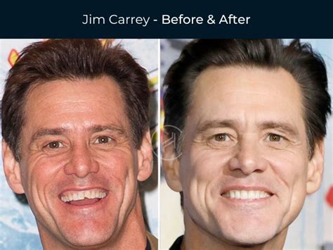 10 Celebrity Dental Implants: Before And After Images! - Dezy