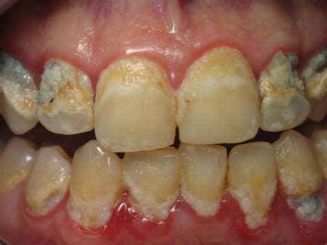 Diseases: Gum Disease Treatment