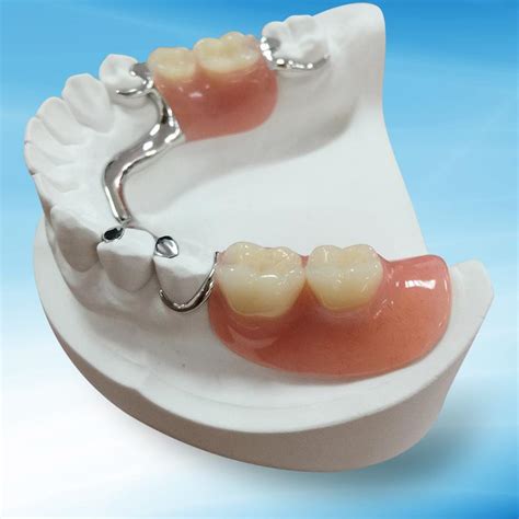 metal frame denture design - adelaidadowker