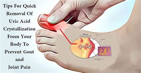 Arthritis in the bones in the feet is often caused by malfunction of ...