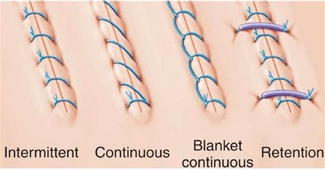 Suture and Suture Materials - www.medicoapps.org