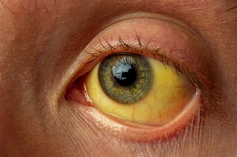 Jaundice: Deciphering The Signs, Risks and Treatment