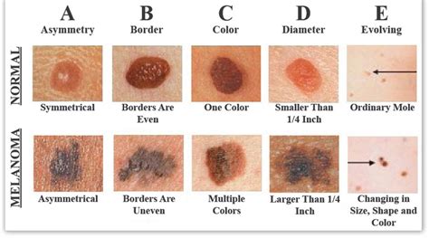 Malignant Melanoma — MC Medical Group