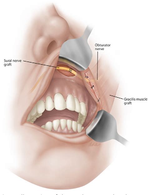 Figure 2 from The Gracilis Free Flap. | Semantic Scholar