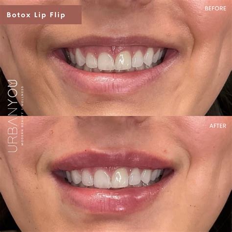 Botox Lip Flip | Before and After | Botox lips, Lip fillers, Botox