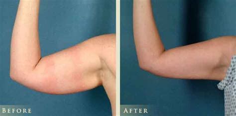 Mothlhtqqjbpqdp: Armpit Lipo Before And After