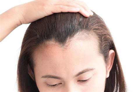 Why Is My Hairline Uneven? Causes & Treatments – DS Healthcare Group