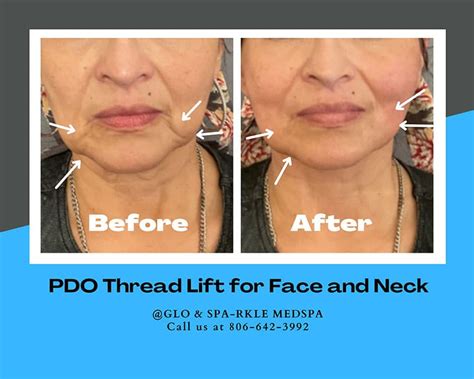 Before & After PDO Thread Lift Procedures in Lubbock | Glo & Sparkle