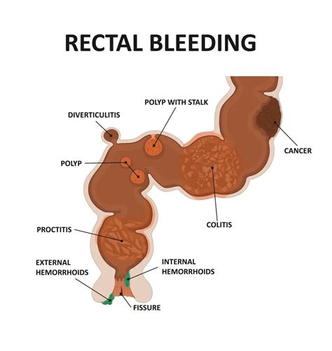 Causes Of Blood In Stool | STD.GOV Blog