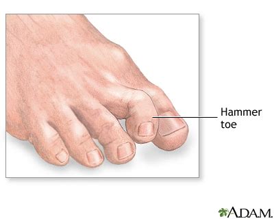 Hammer toe: MedlinePlus Medical Encyclopedia Image