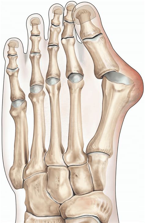 Bunion surgery | healthdirect