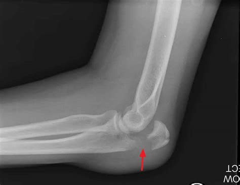 Olecranon fracture causes, symptoms, diagnosis, treatment & prognosis