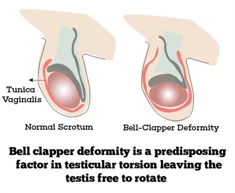 Torsion Testis - Causes, Risk Factors, Symptoms, Diagnosis, Treatment ...