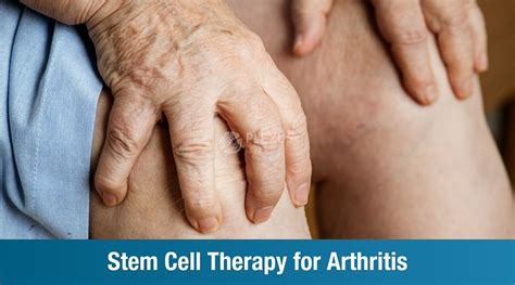 Stem Cell Therapy for Arthritis | Plexus