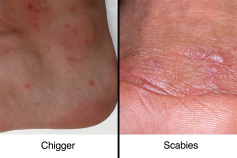 Itchy Bumps On Skin Like Mosquito Bites - Sea Lice That Nasty Rash You ...