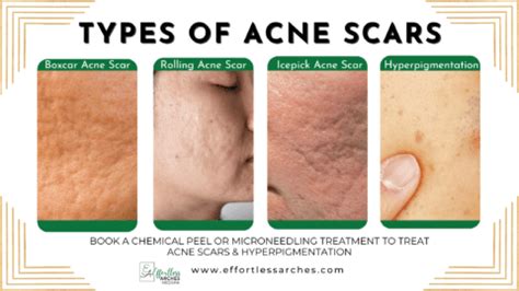 Acne Scars vs Hyperpigmentation: What's The Difference?