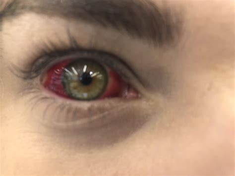 My friend has a burst blood vessel in her eye 😱 : r/eyes