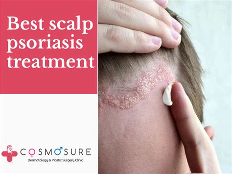 Best Scalp Psoriasis Treatment | Cosmosure Clinic