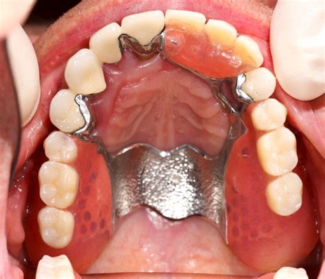 Dentures: Full and Partial, False Teeth Options & Costs UK