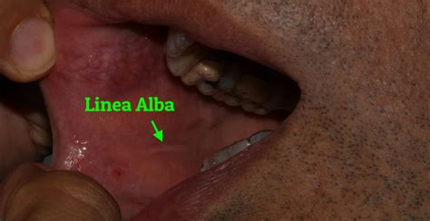 Linea Alba - Brisbane City Dentist