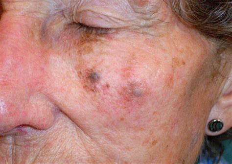 cancerous moles on face pictures | Symptoms and pictures