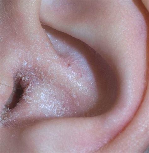 Ear eczema: Symptoms, causes, and treatment