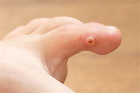 Where Are Plantar Warts Located?: InStride Queen City Foot and Ankle ...