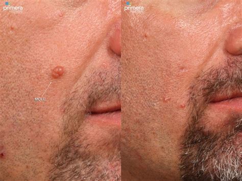 Sebaceous Cyst Face Removal