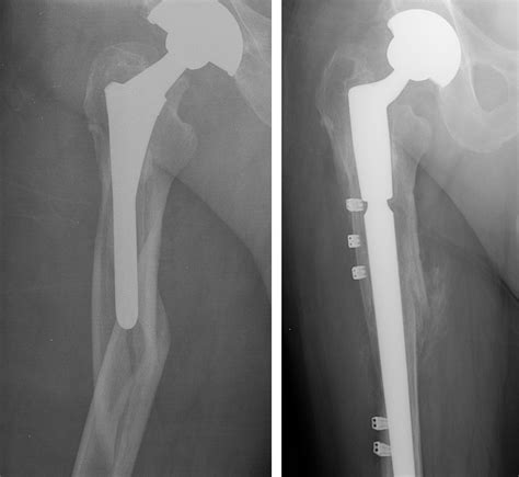 Periprosthetic Fracture After Total Hip Replacement - Dr. Mukhi’s Raj ...