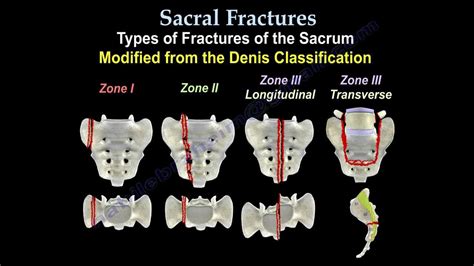 Sacral Fractures – Core EM