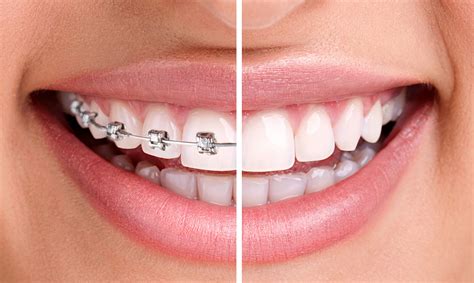 Traditional Metal Braces vs. New Clear Braces | Dr. Mario Paz