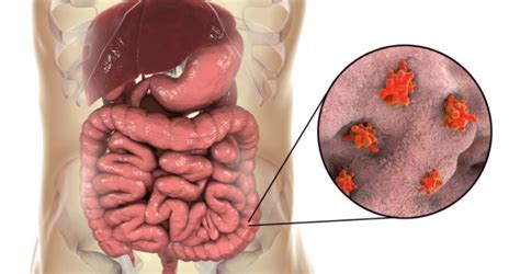 Que Es La Amebiasis Intestinal actualizado - Estudiar