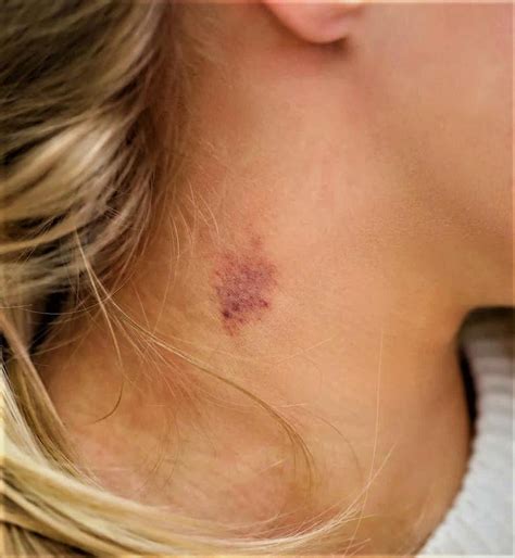 how to get rid of hickeys