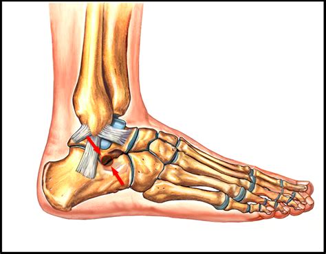 Sinus Tarsi Syndrome - FootEducation