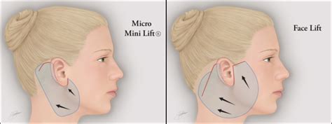 Micro-Mini Lift®: Shorter Recovery Time Than a Facelift