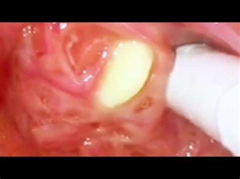 Tonsil Stones and Removal Tools - YouTube