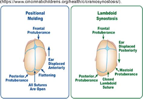 Figure 1 from Exploring infant deformational or positional ...